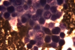 תאים סרטניים במיקרוסקופ